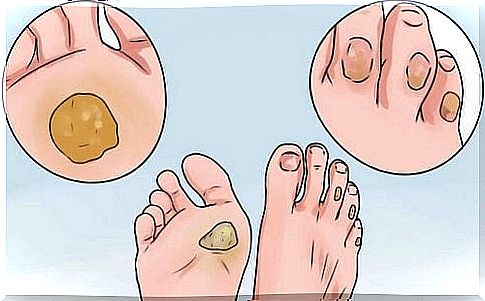 10 remedies for calluses and blisters