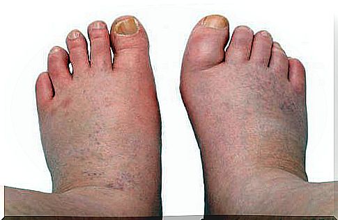 Swollen feet can be a sign of heart disease