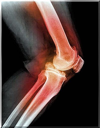 Dislocation of the kneecap