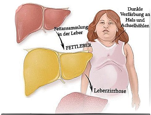 Fatty Liver - Recognizing Symptoms