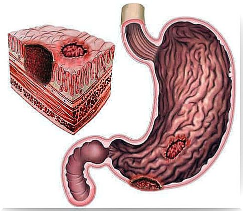 Stomach ulcers and Helicobacter pylori