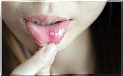 How do you heal aphthae and sores in the mouth?