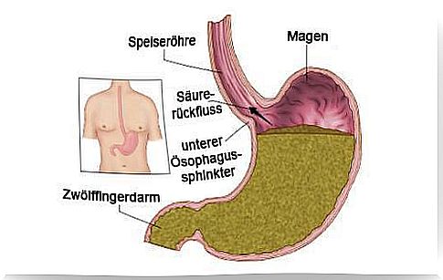 Treatment options for heartburn