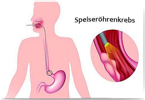 Diseases of the esophagus - most common symptoms