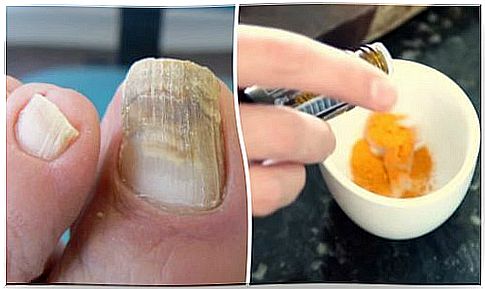 Nail fungus could be treated with turmeric