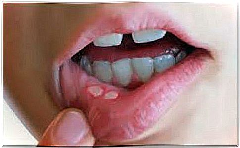 Prevention and healing of mouth ulcers