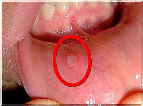 Aphthous ulcers