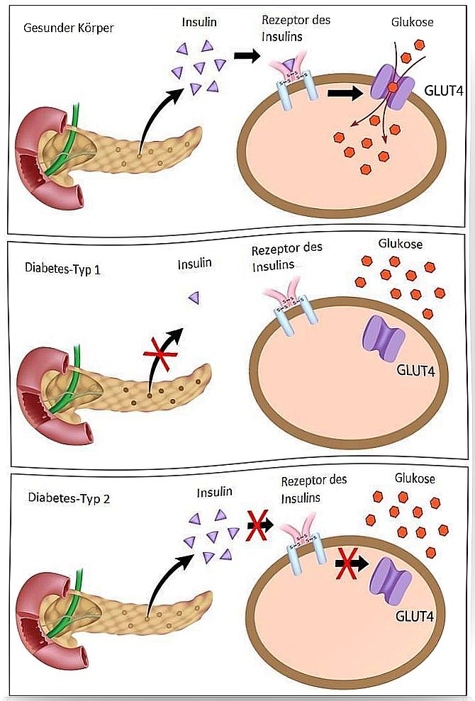 Recognize diabetes