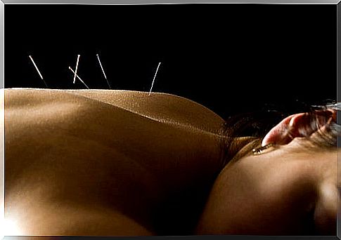 Acupuncture