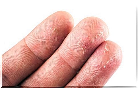 Treating eczema naturally