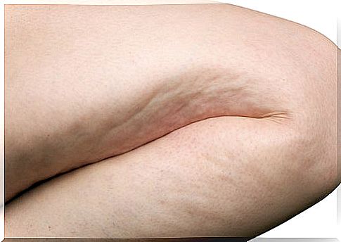 What helps against cellulite?