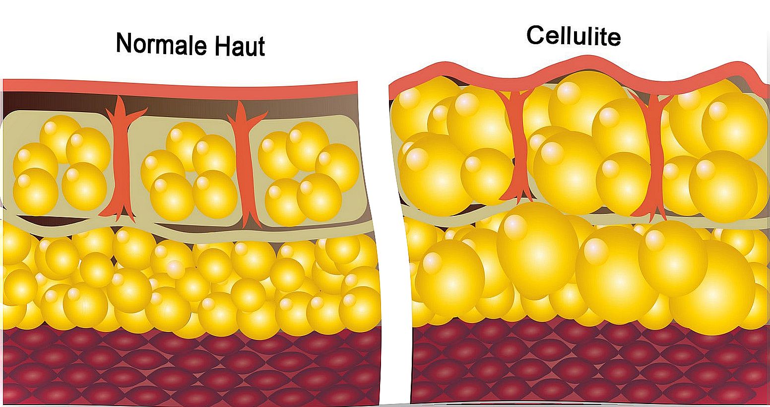 cellulite