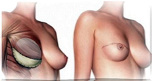 What should you know about a mastectomy?